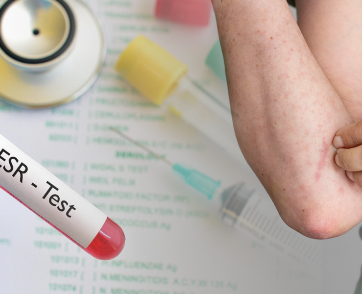 Erythrocyte-Sedimentation-Rate-Test-Psoriatic-Arthritis-Normal-Range-Procedure-Cost